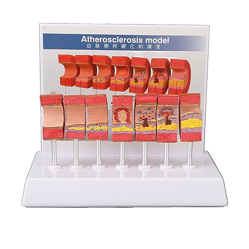 Image of 7PCS Artery Anatomy Model with Atherosclerosis Thrombus Vascular Model for Doctors, Educational Tool