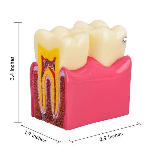 Ultrassist Dental Tooth Decay Model 6 Times Dental Caries Teeth Model Caries Bilateral Comparison Pathology Model Teeth for Dental Education Supplies, Tooth Pathology Display - Thumbnail 6