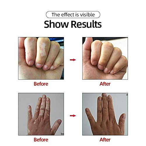 Vitiligo Scars Birthmarks Cover Pen Professional White Spots Tattoo Concealer He #TOP2