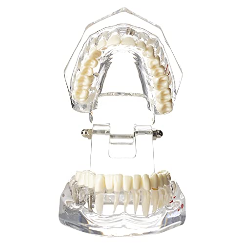 Dentalmall Dental Oral Typodont Model Implant Pathological Removable Teach Demo Visible Anatomy Demonstration Teaching Standard Size (Clear) #TOP3