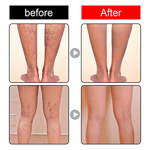 Creme de Cuidado de Veias, Cura eficaz de varizes e vasinhos, Alívio da inflamação da flebite e angi
