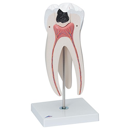 Image of 3B Scientific D15 Giant Molar w / Dental Caries 15x life-size 6-part - 3B Smart Anatomy