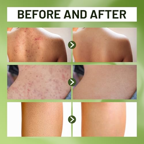ABERA Folliculitis BHA Shower Gel for Body Acne & KP