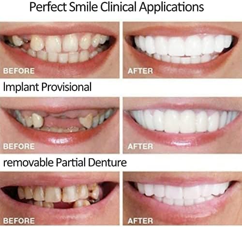Image of 2 Pairs, Adjustable for Men and Women, Regain Confidence Smile, Nature and Comfortable-C03