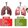 Herbal Lung Cleansing Spray, Respinature Herbal Lung Cleanse Mist, Natural Herbal Lung Essence, Spray Cleansing Lung, Powerful Lung Support, Clears Lungs of Waste and Mucus, Promotes Lung Health