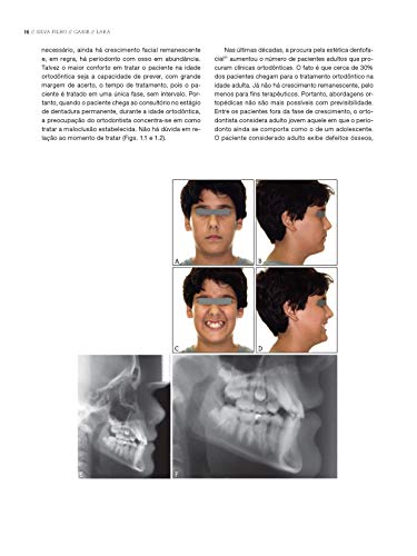 Ortodontia Interceptiva: Protocolo de Tratamento em Duas Fases