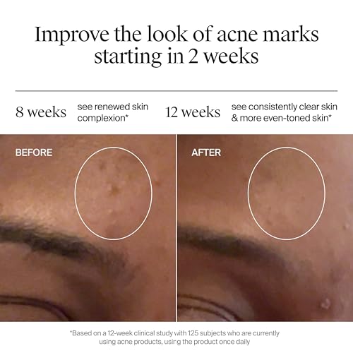 Image of Neutrogena Evenly Clear Retinoid Adapalene Gel 0.1% Acne Spot Treatment, Once-Daily Topical Retinoid Helps Clear Breakouts & Visible Improvement in the Appearance of Post-Acne Mark, 0.5 oz