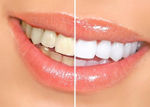 image for Smilebriter Teeth Whitening Gel Pens, 2 Pens :: No Peg, PPG, Artificia