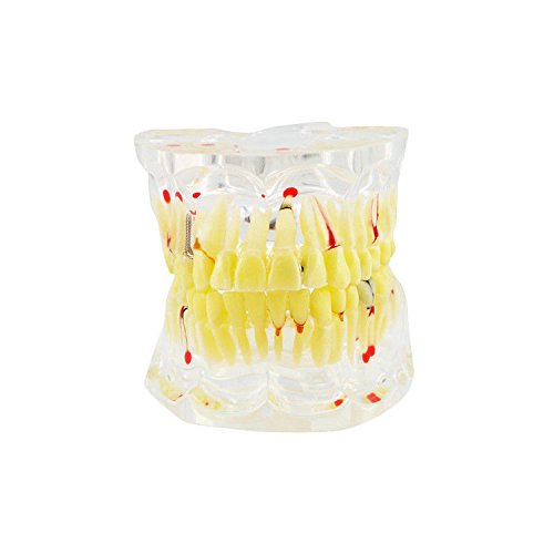 Doc.Royal Dental Teeth Study Model Classic Implant Model with Restoration