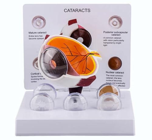 Eye Model, Cataract Eye Model,Anatomical Eyeball Model for Human Anatomy, Physiology Education, Anatomy Model Science Classroom Study Display Medical Education