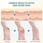 40% Urea Cream for Feet – Foot Cream with 2% Salicylic Acid for Dry Cracked Heels and Feet, Urea 40% Foot Lotion, Formulated with Shea Butter, Tea Tree Oil for Deep Moisturizing(5.29oz) - Image 4