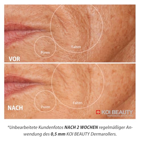 Dermaroller Koi Beauty 1,5 mm mit 200 echten Nadeln