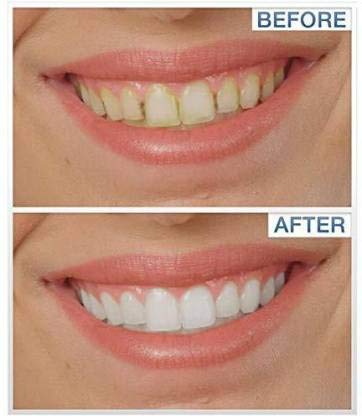 Sonic Pic Denture Kit Removes Plaque Tartar Stains From Teeth Home Dental Cleaning Kit Amazon In Health Personal Care