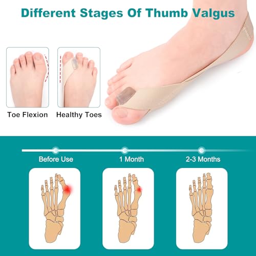 Image of Bunion Corrector Bunion corrector for women big toe Effective Pain Relief Comfortable big toe straightener Adjustable Design For both women and men