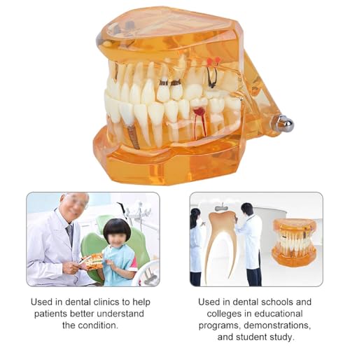 Natudeco Zahnmodell Dentalmodell Zahnkrankheits-Lehrmodell Dental Maxillary Overdenture Model Minderwertiges Präzisionsimplantat Demo with 4 Implantats for Zahnarztlaborklinik Zahnarztköpfe