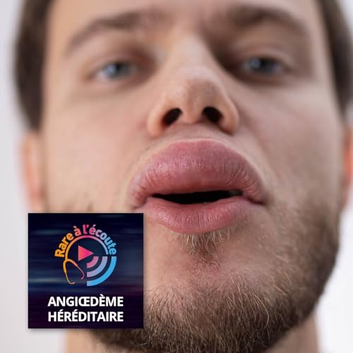 Maladie rare &ndash; Prise en charge de l&rsquo;angi&oelig;d&egrave;me h&eacute;r&eacute;ditaire : point sur les nouvelles recommandations