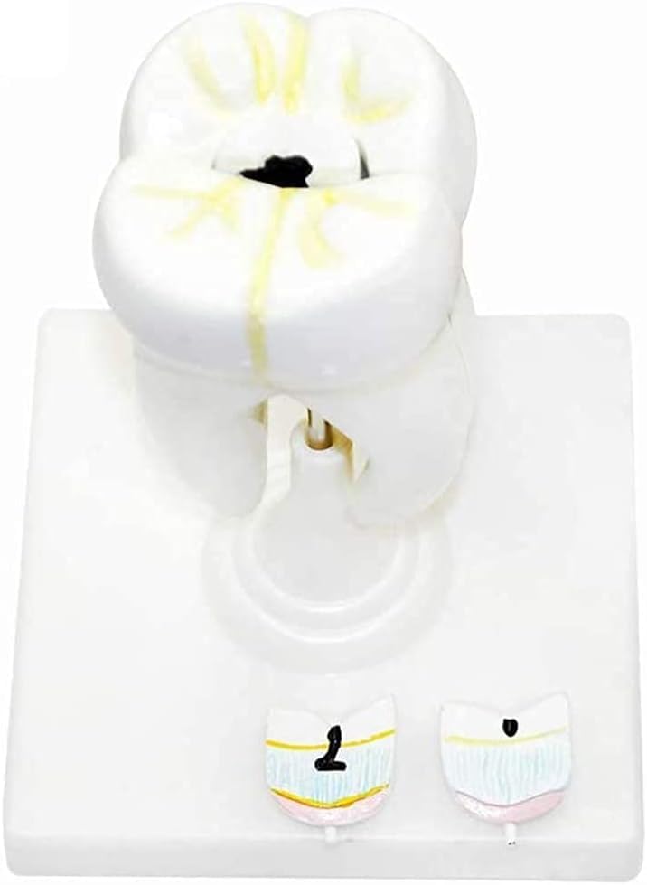 ERNZI Modèle Dentaire, Démonstration Biomédicale Enseignement De Anatomie des Dents Humaines, Modèle De Carie Dentaire Molaire, Modèle Enseignement Standard pour Adultes