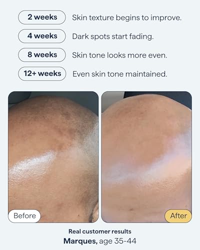 Remedy Science Remedy for Dark Spots | Advanced Discoloration Correcting Serum | Retinol, Kojic Acid, Tranexamic Acid, Niacinamide, Mandelic Acid | Fragrance Free, Sensitive Skin | By Dermatologist Dr. Shah | 1fl oz