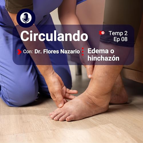 Piernas hinchadas y enfermedades vasculares: c&oacute;mo identificar y tratar el edema. 🦵🔬 | Dr. Flores Nazario
