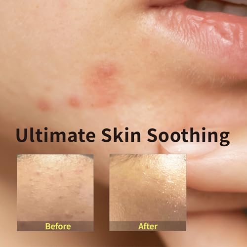 Image of Redness Relief Face Cream for Sensitive Skin, Barrier Repair Moisturizer with Ceramide, Panthenol & 8-Type Hyaluronic Acid, Soothing & Hydrating, Korean Skincare, 1.69 fl oz
