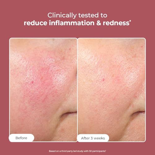 Image of Conscious Chemist Sunscreen & Azelaic Acid Cream Combo | SPF 50 PA++++ In-Vivo Tested | Sunscreen with Niacinamide & Blackberry | 10% Azelaic Acid Face Cream for Acne-Prone Skin, Redness Relief | All Skin Types - Berry Bright & Azicalm