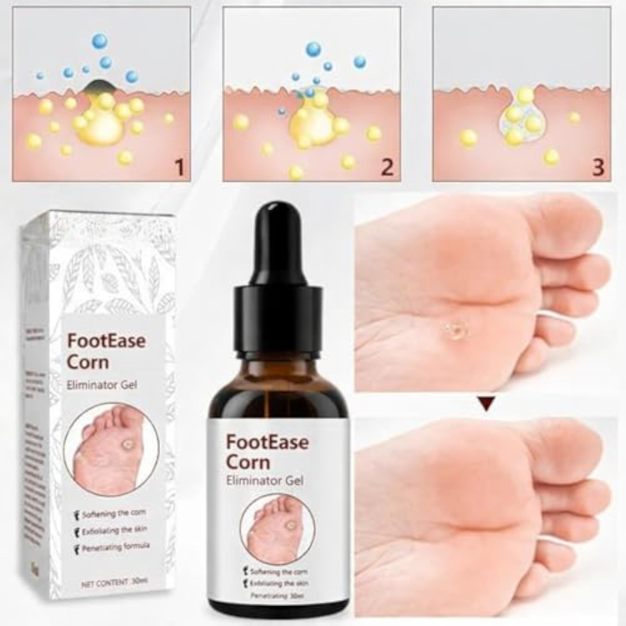 Advanced Foot Corn Removal Gel - 30ml