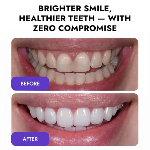 Image of Whitening Foam 50ml - Brightening White Teeth Colour Corrector for Whiter, Brighter Smile - Advanced Tooth Whitening Foam