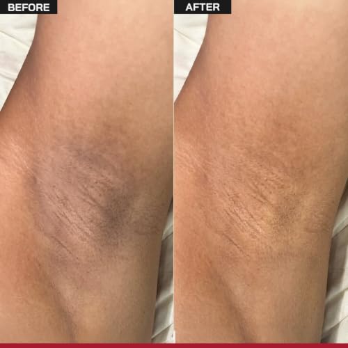 Image of /PHD / 6% AHA Underarm Roll-On Deodorant | Reduces Underarm Pigmentation & Body Odor | Brightens Dark Underarms for Even Skin Tone | Fragrance-Free | 50 ml