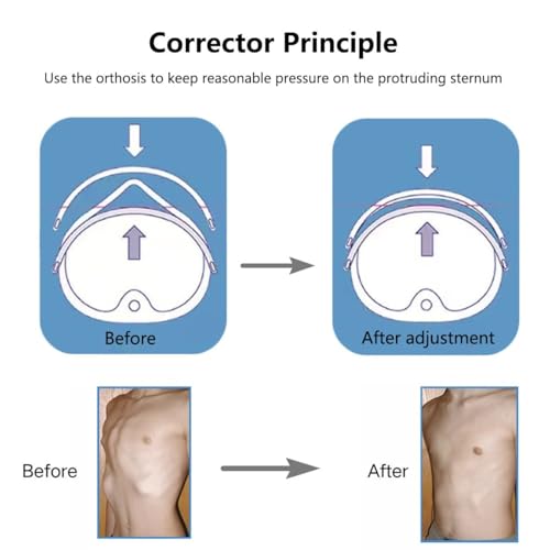 Pectus Carinatum Orthosis Brace - Fijación torácica ajustable para todas las edades - Correctores de costillas valgus