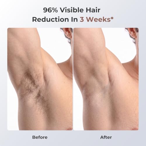 Image of Ubroo IPL Laser Hair Removal Device, 21J Energy, 41F Ice Cooling