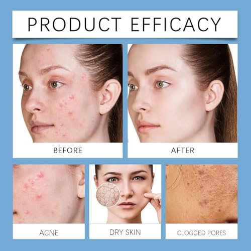 Qklovni 3Pcs Norse Organics Acne & Redness Killer, Norse Organics Acne Balm, Ultra-Performance Skincare, Acne Remove Skin Care Set, Acne Clearing Cream for All Skin Types
