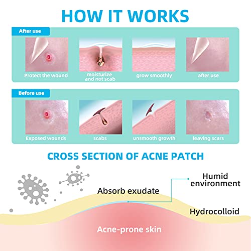 ACOTYE 2022 Pimple Patches 105PCS with Tea Tree Oil, Salicylic Acid and Niacinamide, Blemish Spot, Fast Healing, Invisible Hydrocolloid Patches, 4 Sizes 8mm, 10mm, 12mm,14mm (Updated Version) (105pcs)