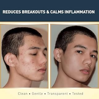 Jericho Dead Sea Sulfur Soap with Olive Oil – Helps with Acne, Psoriasis, Eczema & Blackheads – For Oily to Normal Skin – Vegan Face & Body Bar for Men & Women, 4.4 Oz / 125 g (Pack of 3)