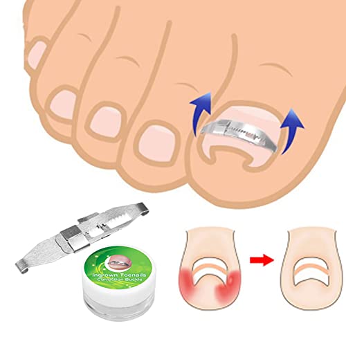 Ingrown Toenail Treatment, Ingrown Toenail Corrector, Ingrown Toenail Tools - Image 3