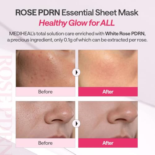 Image of MEDIHEAL Rose PDRN Essential Sheet Mask (1 Sheet) Hydrating & Firming Korean Face Mask with 99% Pure White Rose PDRN & Hyaluronic Acid, Moisture Barrier Repair & Healthy Glow, Vegan Formula