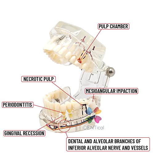 Image of iDENTical Patient Education Model (Caries, Implant, Nerves) M2001-3 | 3D Model | Featuring More than 30 Clinical Findings | Illustrative | Durable | Portable