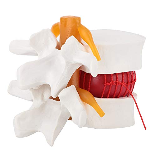 flexman Human Anatomical Lumbar Disc Herniation Model, 1:1.5 Plastic Fourth and Fifth Lumbar Medical Demonstration Model for Teaching Demonstration
