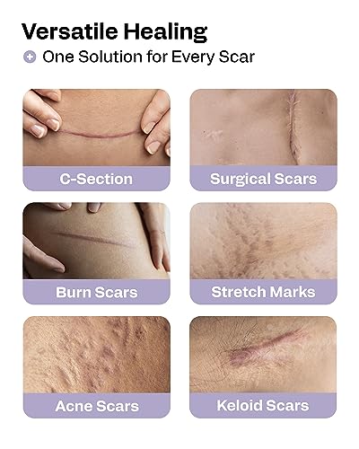 awd silicone scar sheets for surgical scars - seamless medical grade silicone scar tape for c section tummy tuck tape - silicone skin patches after surgery must haves 1634 x 6034 seamless roll