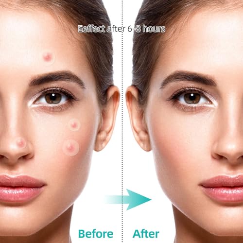 LOPHE Pimple Patch, 504 Stück Hydrokolloid Acne Patch Unsichtbare Natürliche Akne Patches, Tag Und Nacht 2-In-1 Wasserdicht Absorptions Pickel Patch