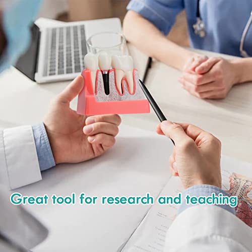 Lvchen Dental Implant Model - 4 Times Crown Bridge Explanation Model Implant Analysis Tooth Model Removable Crown Cross-Section Demonstration For Study And Teaching #TOP5