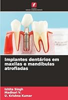 Implantes dentários em maxilas e mandíbulas atrofiadas (Portuguese Edition) 6203919349 Book Cover