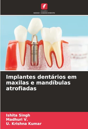 Implantes dentários em maxilas e mandíbulas atr... [Portuguese] 6203919349 Book Cover