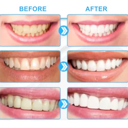 Bleaching Teeth Set- Professional Teeth Whitening Kit For Home Use, 6 Whitening Gels & 2 Desensitizing Gels, Safe For All Teeth Types, Easy To Use For Smokers/Coffee Lovers - 2