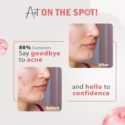 Image of Glamveda 3% Kojic Acid Acne Spot Corrector Gel For Reduce Acne Scars & Dark Spots | Day & Night Gel | Skin Brightening & Pigmentation Removal | With Alpha Arbutin & Niacinamide | 20g