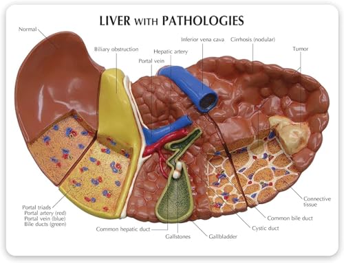 Modèle foie avec pathologies pour simplifier l'explication médicale