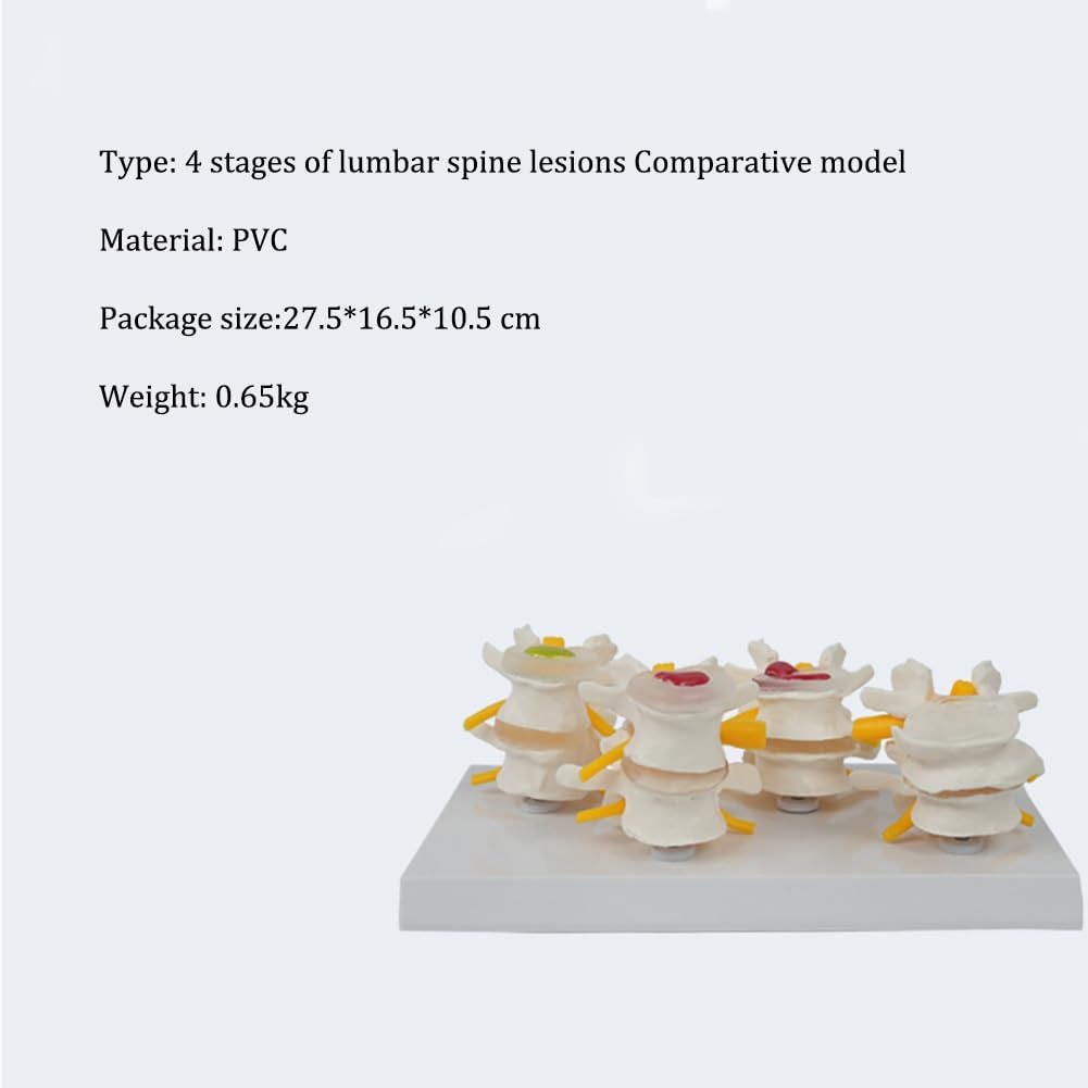 4 Stages Lumbar Spine lesions Comparative Model