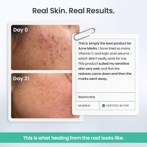 Image of The Solved Skin Spot Fade Advanced Repair Serum with 8% Solubilized Azelaic Acid & 4% Niacinamide for Post-Acne Marks, Redness, Pigmentation & Even Tone | Gentle, Lightweight Face Serum for Sensitive, Oily & Acne-Prone Skin - 30ml