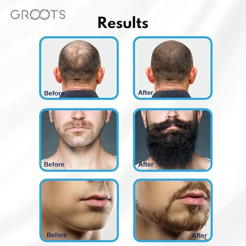 Image of GROOTS Derma Stamp for Hair Growth & Facial Spa | Titanium Coated Adjustable Needles 0.25mm to 3mm | 140 Microneedling Stamp for Skin Repair, Face, Hair & Beard Growth | Reduces Acne Scars | Safe & Effective To Use