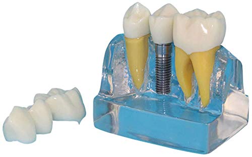Modèle De La Dent Humaine, Modèle Dentaire Transparent Personnes Modèle Oral, Implant Dentaire Utilisé pour La Recherche dans Les Domaines De La Communication Ou L'Affichage Patients