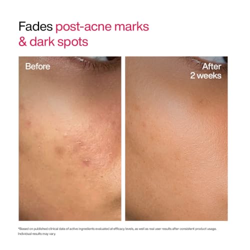 Image of WishCare Advanced Dark Spot Correcting Serum - TXA Shot | 10% Niacinamide Serum For Pigmentation and Dark Spot | With 2% Alpha Arbutin & TXA for Glowing Skin | 30ml